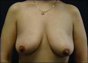 30 year old female Chicago Breast Augmentation Pictures