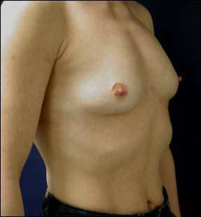 23 year old athletic female Chicago Breast Augmentation pictures