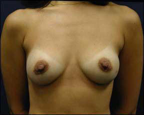 39 year old female Chicago Breast Augmentation Photo