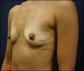 39 year old female Chicago Breast Augmentation Pictures