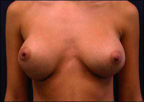 Breast Augmentation - Breast Augmentation & Breast Augmentation Surgery