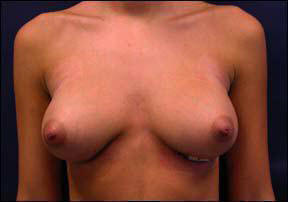 Breast Augmentation - Breast Augmentation & Breast Augmentation Surgery