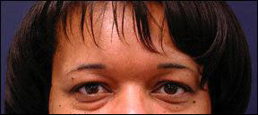 Blepharoplasty Picture - Varied Skin Tone