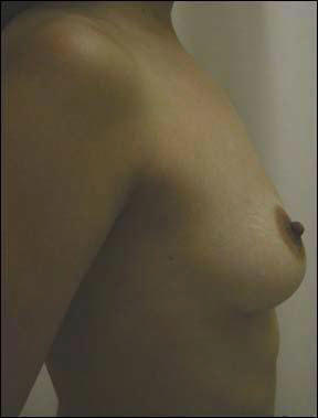 Breast Augmentation - Breast Augmentation & Breast Augmentation Surgery