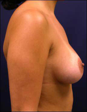 Breast Augmentation - Breast Augmentation & Breast Augmentation Surgery