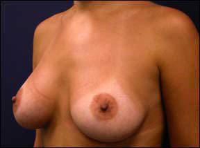 Breast Augmentation - Breast Augmentation & Breast Augmentation Surgery