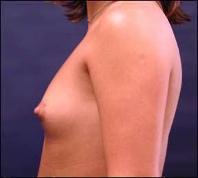 Breast Augmentation - Breast Augmentation & Breast Augmentation Surgery