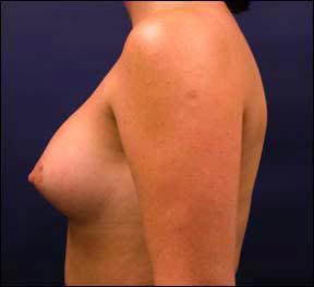 Breast Augmentation - Breast Augmentation & Breast Augmentation Surgery