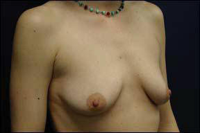 breast augmentation picture photo 7c.jpg
