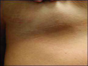 breast-augmentation-scar11.jpg