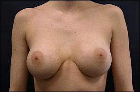 Breast Augmentation - Breast Augmentation & Breast Augmentation Surgery
