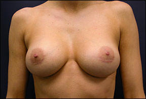 Breast Augmentation - Breast Augmentation & Breast Augmentation Surgery