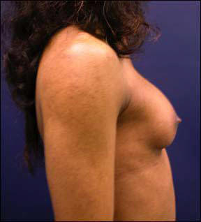 Breast Augmentation - Breast Augmentation & Breast Augmentation Surgery