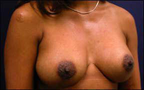 Breast Augmentation Before and After - Notice the improved projection after surgery.