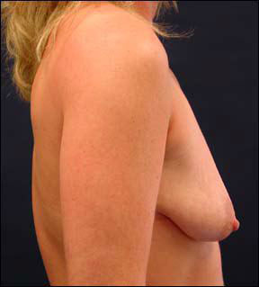 contoured implants