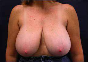 Breast Reduction Picture - No Horizontal Scars