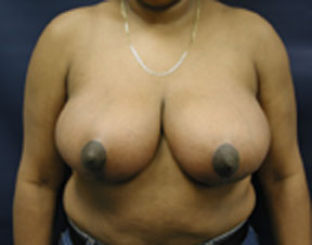 Breast Reduction Photo- Great Results