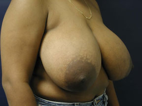 Breast Reduction Photo - Patients of All Ages