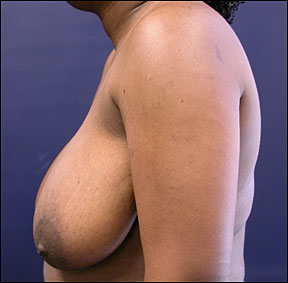 Breast Reduction Picture - The Post-Surgical Results