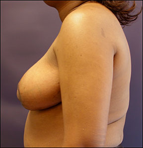 Breast Reduction Picture - Bilateral Reduction Results