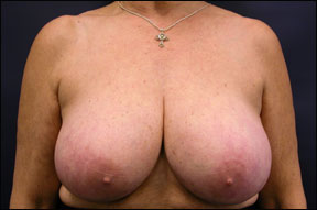 Breast Reduction Surgery - Bilateral Vertical Reduction