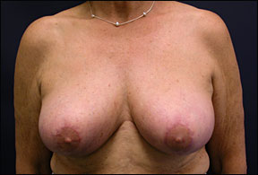 Breast Reduction Surgery - Post-Operative Results