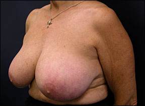 Breast Reduction Surgery - Patient Photos