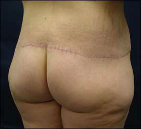 Butt - Improving Your Appearance