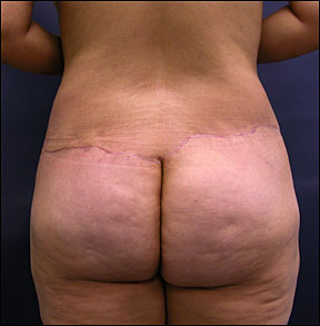 bum surgery