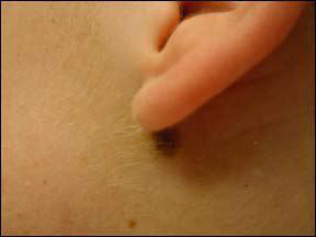 Laser Mole Removal - Laser Treatments