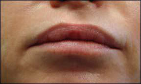 Lip Augmentation Picture - Radiance and Cymetra Results