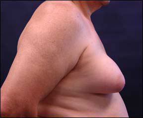 Gynecomastia Picture - See Before and After Photos