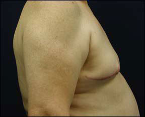 Gynecomastia Picture - See the Results