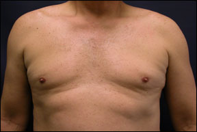 Gynecomastia Picture - Liposuction Correction