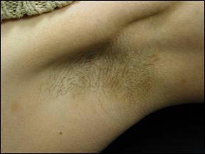 Chicago Laser Hair Removal - Underarms