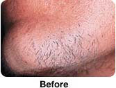 Hair Removal - Male patient Before and After