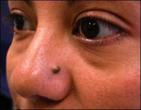 Mole - Brownish Skin Growth