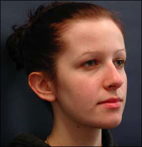 Otoplasty Picture - Children and Adults