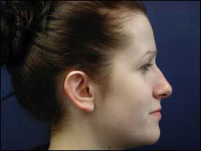 Chicago Otoplasty