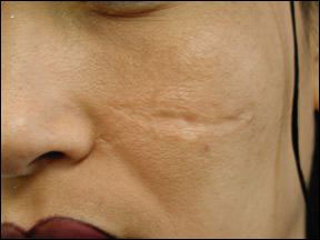 Scar - Removal and Treatment