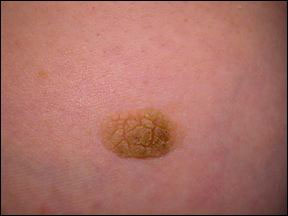 Seborrheic Keratosis - Skin Growth