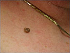 Skin Tag - Description