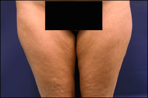 Thigh Lift Picture - The Before Pictures