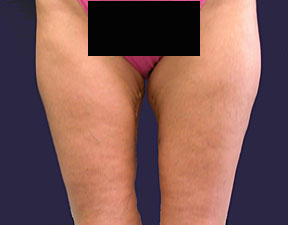 Thigh Lift Picture - After Pictures
