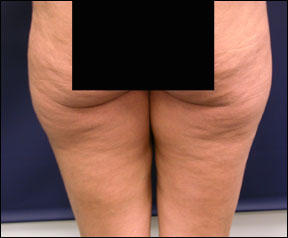 Thigh Lift Picture - Excess Skin
