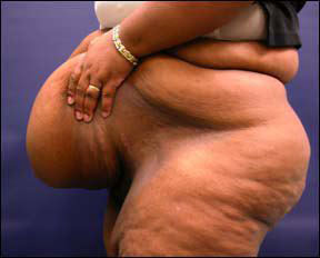 Tummy Tuck Pictures