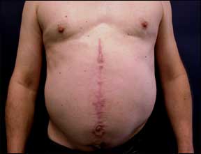 Tummy Tuck Picture