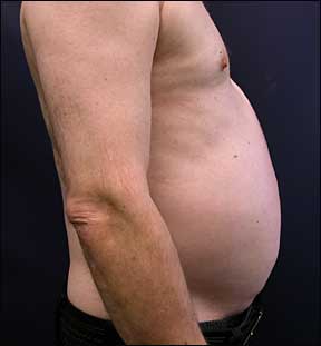 Tummy Tuck Picture