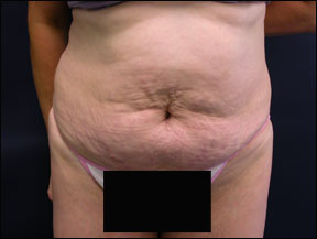 Tummy Tuck Photo - Full Tummy Tuck Scar