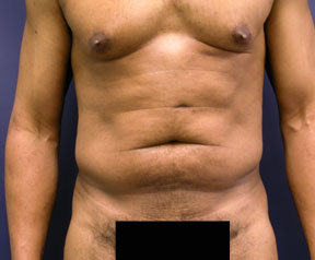 Abdominoplasty Photo - Male Result